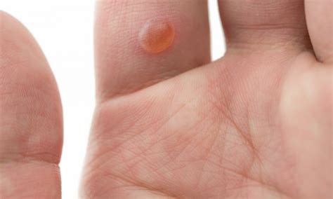 Should I pop the blood blister on my finger? | Smart Tips