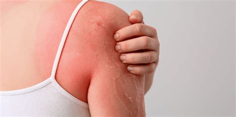 Sunburn Treatment and Prevention