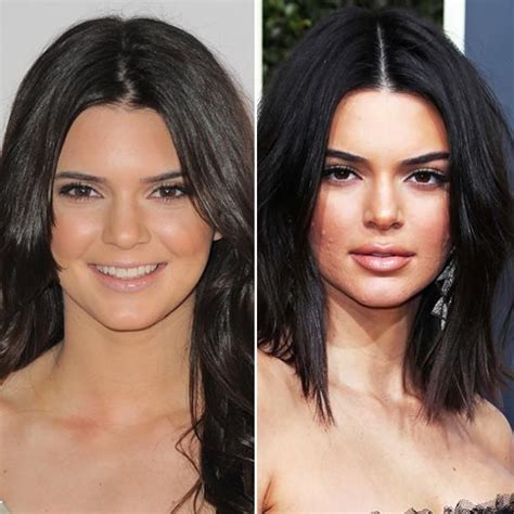 Kendall Jenner Lip Injections, Kendall Jenner Plastic Surgery, Face ...