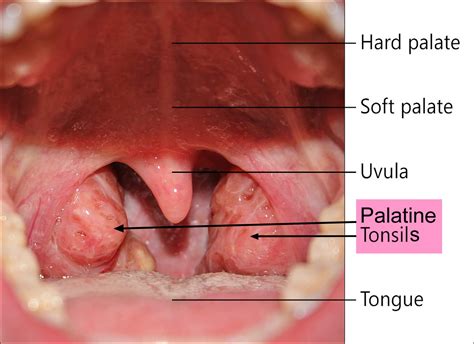 Normal Tonsils