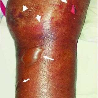 Fig. Photograph showing non-blanchable, purple coloured skin lesions... | Download Scientific ...