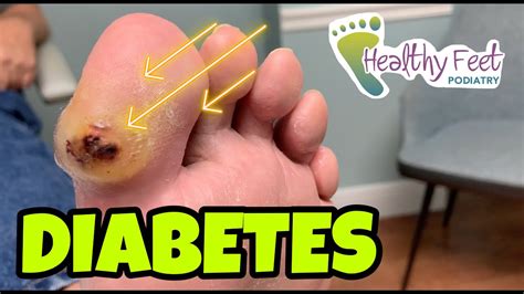 Diabetic Blisters On Feet