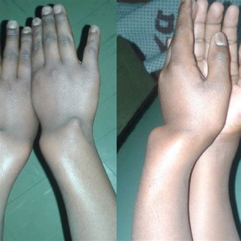 (PDF) Jaccoud's Arthropathy with Radial Shaft Deformity in a Patient with a History of Mild ...