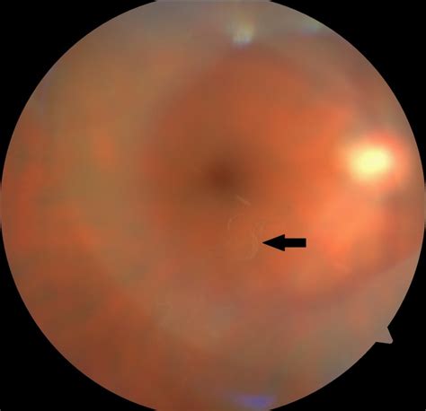 [Figure, Color fundus photo showing a Weiss ring Contributed by Koushik Tripathy, MD ...