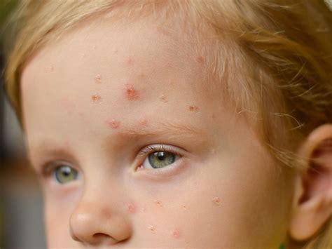 Scarlet fever: Symptoms to look out for and how to treat