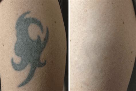 Tattoo Removal With the PicoSure® Laser | The Spa at Spring Ridge