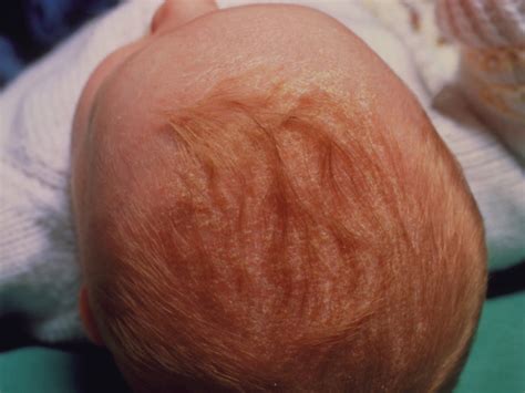 Cradle Cap Symptoms And Treatments