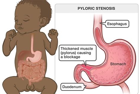 Pyloromyotomy Treatment : GetWellGo - India's Best Healthcare Services