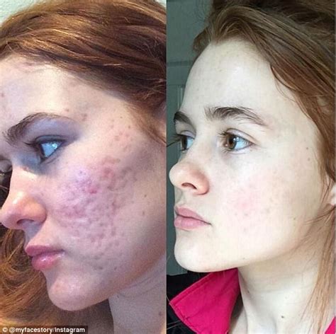 Ohio woman posts before-and-after acne Instagram photos | Daily Mail Online