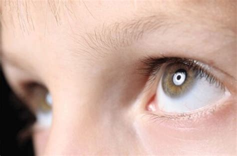 Nystagmus: Ayurvedic Treatment of Nystagmus | Consult Online