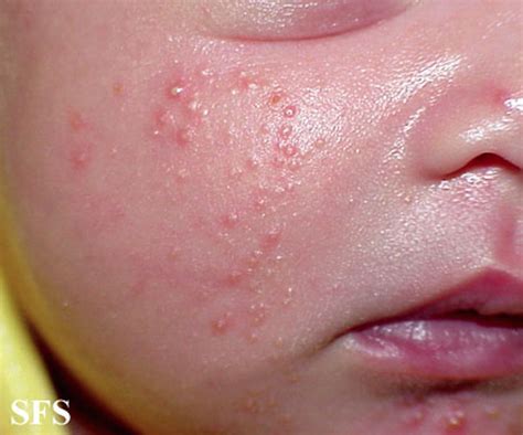 Neonatal acne - wikidoc