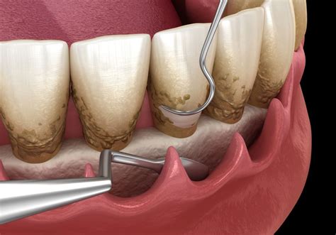 Curettage of the periodontium | City Dental Clinic | Bratislava