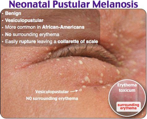 Neonatal Pustular Melanosis Rosh Review | Pediatrics, Pediatry, Dermatology