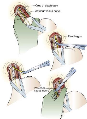 Truncal Vagotomy and Pyloroplasty and Highly Selective Vagotomy | Basicmedical Key