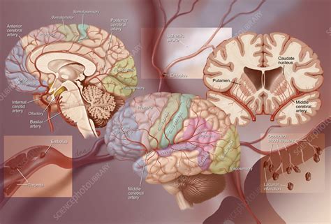 Anatomy of ischemic stroke, illustration - Stock Image - C057/3375 - Science Photo Library