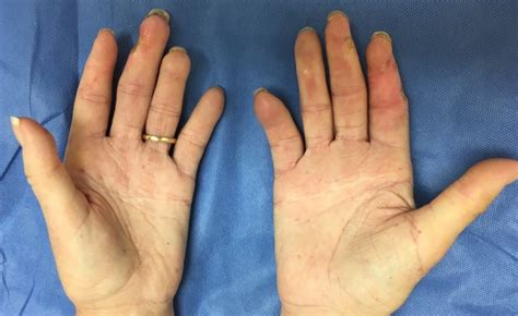 SCLERODERMA (SYSTEMIC SCLEROSIS, CREST) | Hand Surgery Resource