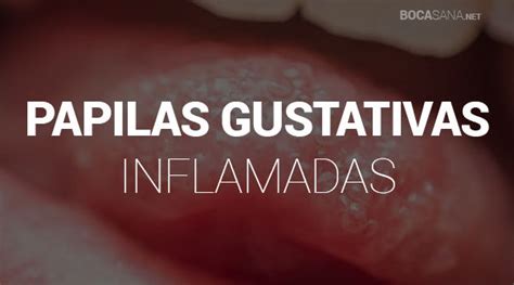 ⊛ Papilas Gustativas Inflamadas 【 ¿Por Qué Ocurre? 】2024