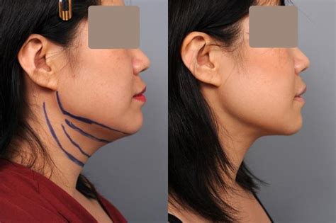 Skinny Lipo Of Neck Of Chin With Laser