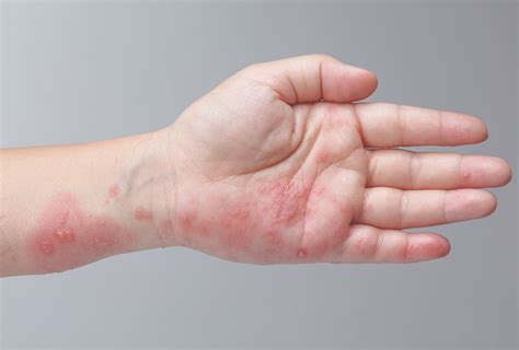 Scabies: Causes, Symptoms, Treatment, & Complications