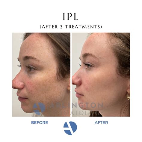 IPL Laser Resurfacing Near Me Arlington, VA | DC, McLean