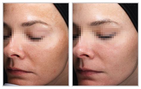 Tips For Taking The Best Before-And-After Photos Of Your Skin-Resurfacing Patients — Sciton Blog