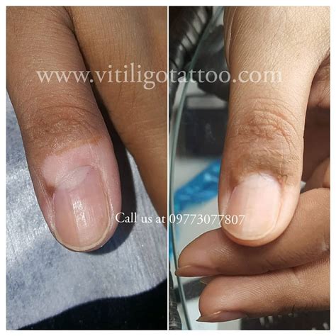 Cost Of Vitiligo Treatment – Vitiligo Tattoo