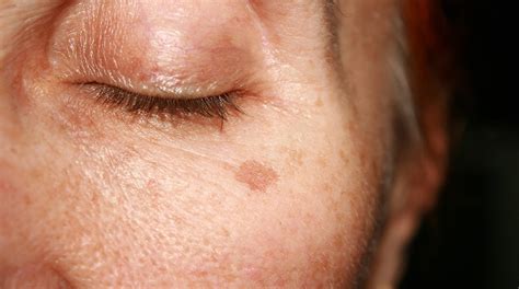 Brown Spots On Your Skin