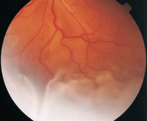 Exudative retinal detachment is present in a 23-year-old male patient ...