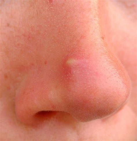 Cyst on nose: 5 Detailed Causes, Symptoms and Treatment