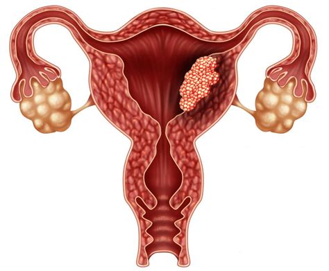 Endometrial Cancer Endometrial cancer - Diseases Club Center 2