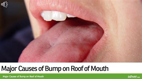 What could a lump or bump on the roof of your mouth be? - mccnsulting ...