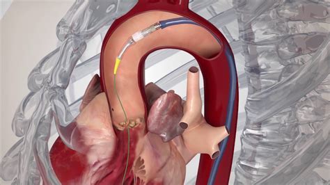 Transcatheter Aortic Valve Replacement (TAVR) for Aortic Stenosis - YouTube