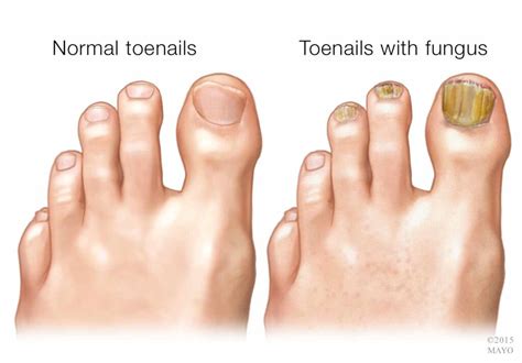 Why does nail fungus cause thick toenails? - Toenail Fungus Treatment Center