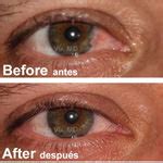 Pterygium Surgery Before & After Photos Monterey Park