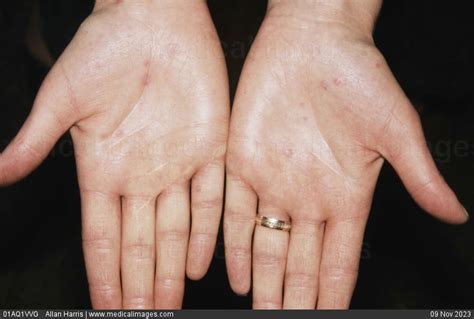 What causes blisters on palms of hands