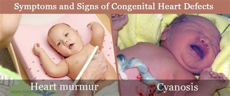 Congenital Heart Defects - Causes, Symptoms, Diagnosis & Treatment