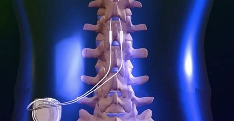 Global Spinal Cord Stimulation Devices Market 2016-2020 with Boston Scientific, Medtronic, Nevro ...