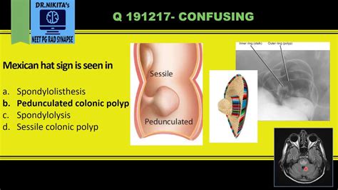 MEXICAN HAT SIGN- PEDUNCULATED COLONIC POLYP- RADIOLOGY - YouTube