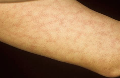 livedo reticularis rash - pictures, photos