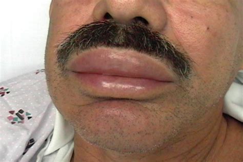 What Causes Angioedema Of The Lips | Lipstutorial.org