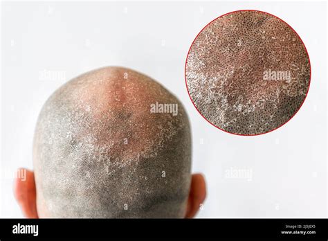 Man's bald flaky head with dandruff close-up, back view. White ...