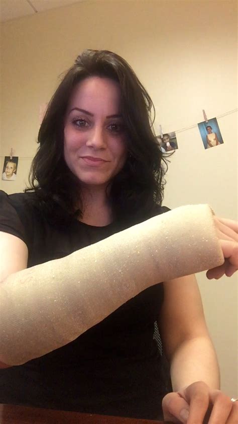 Broken Wrist Cast