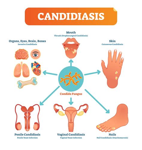 Candidiasis: causas, síntomas y consejos - Blog de Naturlíder : Blog de Naturlíder