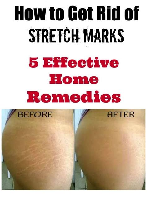 How to Get Rid of Stretch Marks: 5 Effective Home Remedies | Stretch marks, Stretch mark ...