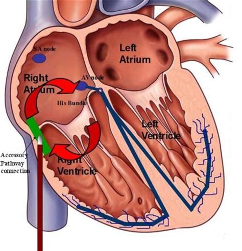 The Implantable Medtronic Cardiac Loop Recorder: A Personal Experience - Patient's Lounge