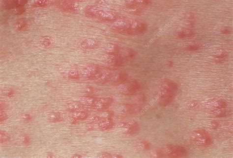 Red papules on the skin due to scabies - Stock Image - M260/0127 ...