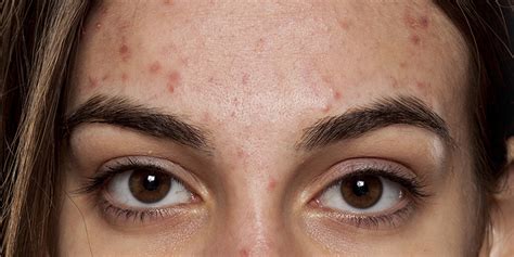 Nodular Acne: Causes, Treatments Options And Prevention Tips