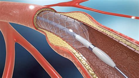 Coronary Intervention - Heart & Vascular