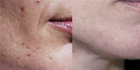 Ice Pick Excision - Acne Scars Excision Treatment Florida