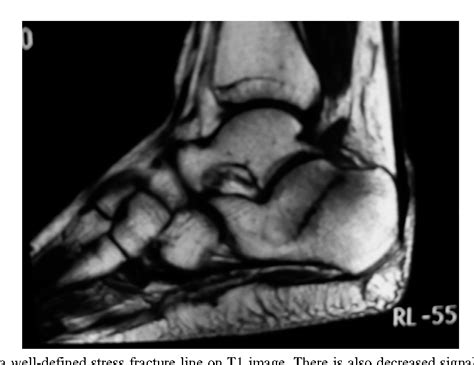 Figure 1 from Bilateral calcaneal stress fractures: a case report. | Semantic Scholar